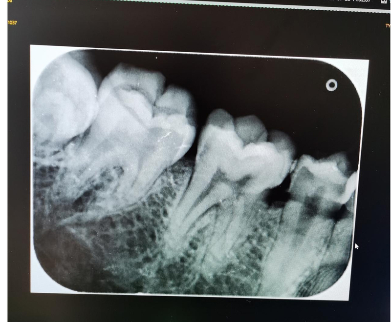 Máquina de rayos X dental montada en la pared